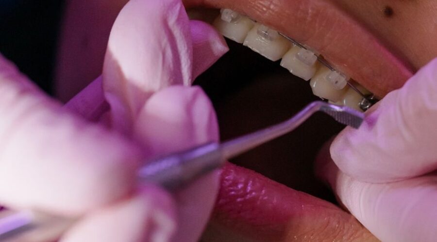 bambini denti storti