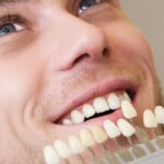 faccette dentali