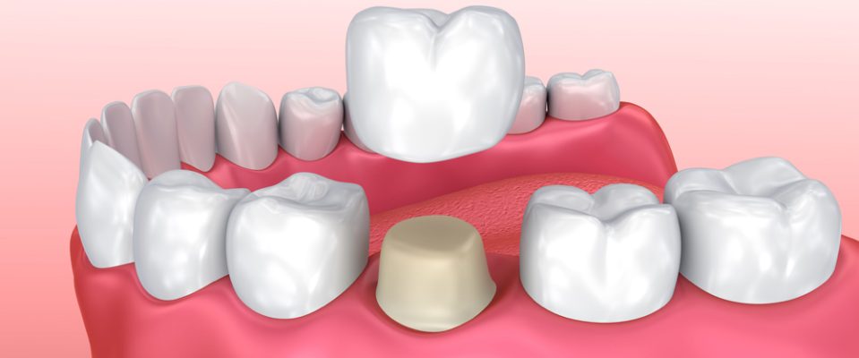 Dental crown installation process, Medically accurate 3d illustration Dental crown installation process, Medically accurate 3d illustration