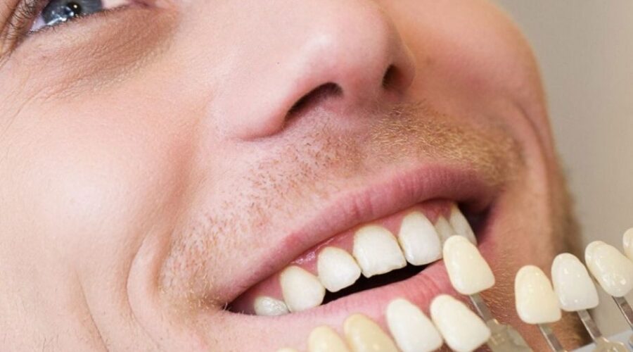 faccette dentali